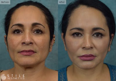 Facelift Before & After Gallery - Patient 106657 - Image 1
