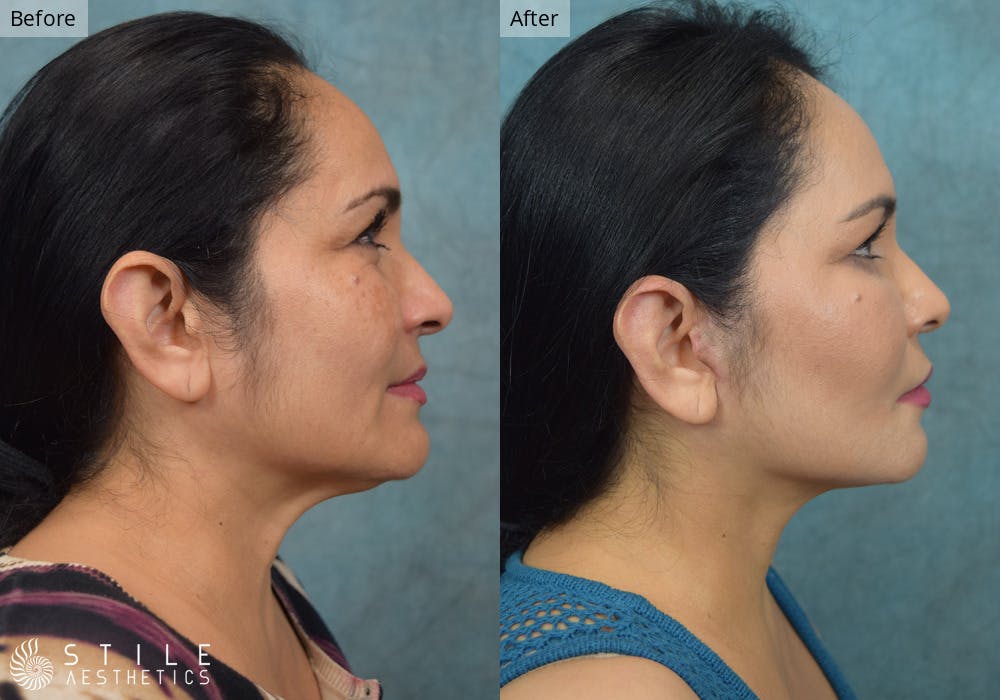 Facelift Before & After Gallery - Patient 106657 - Image 2