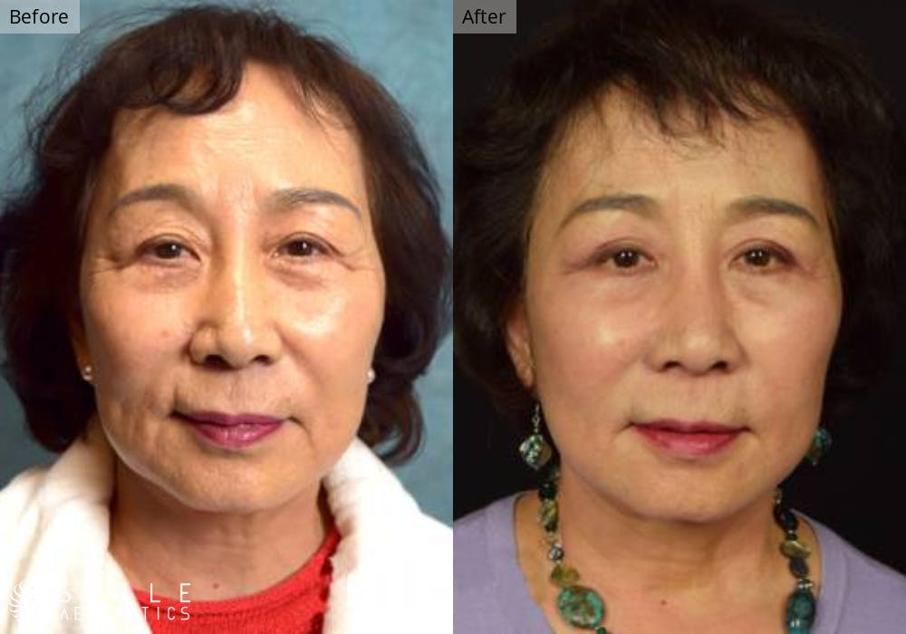 Facelift Before & After Gallery - Patient 271379 - Image 1