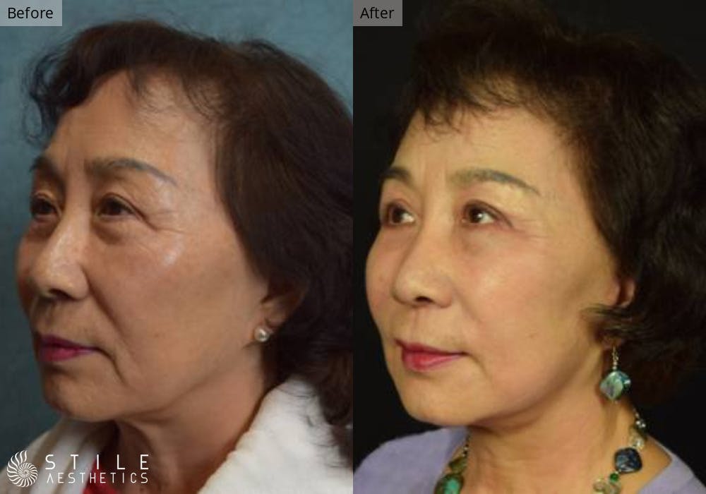 Facelift Before & After Gallery - Patient 271379 - Image 2