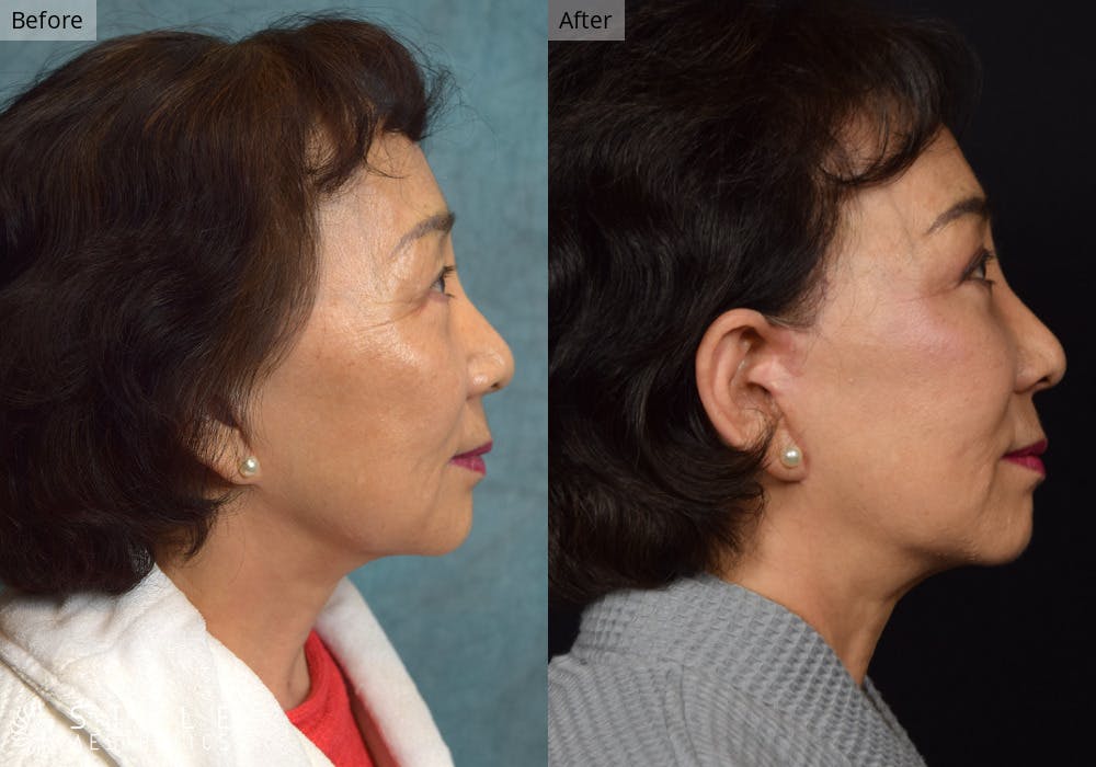 Facelift Before & After Gallery - Patient 271379 - Image 3