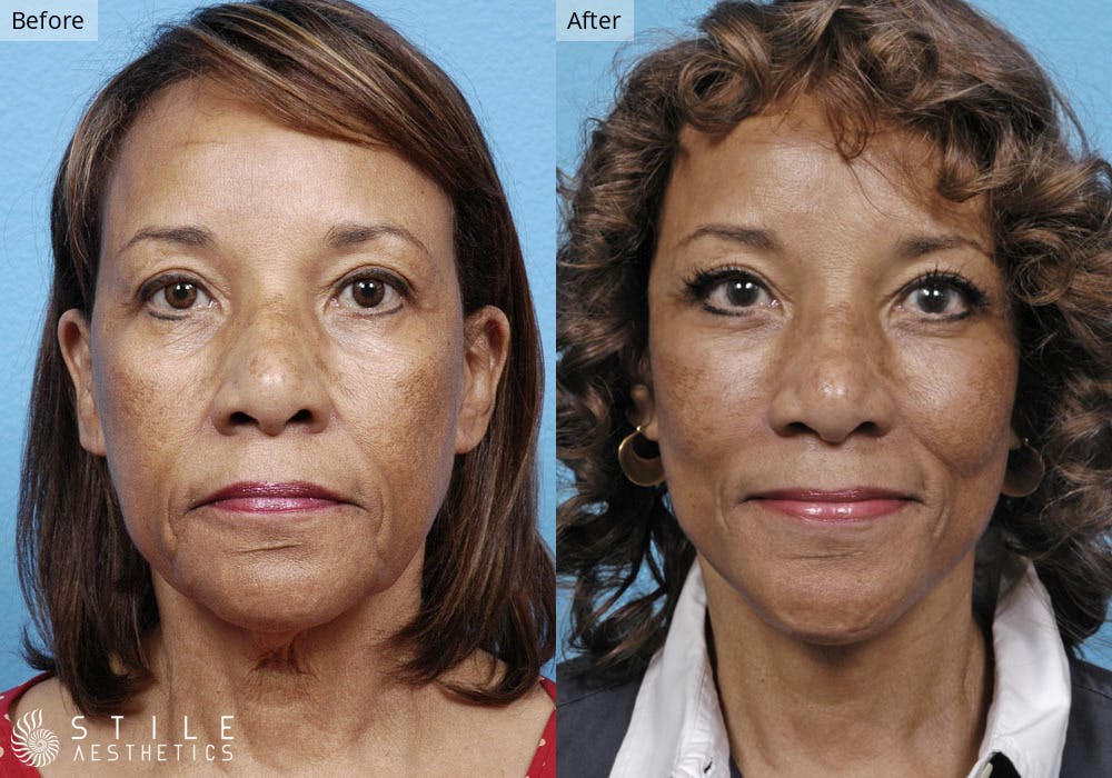 Facelift Before & After Gallery - Patient 804819 - Image 1