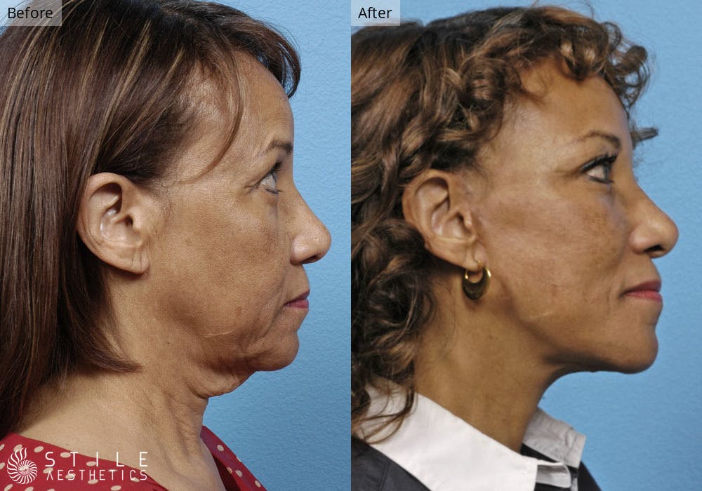 Facelift Before & After Gallery - Patient 804819 - Image 2