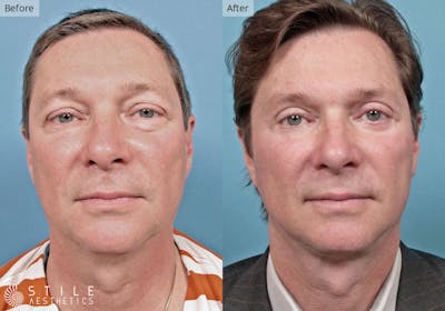 Facelift Before & After Gallery - Patient 192591 - Image 1