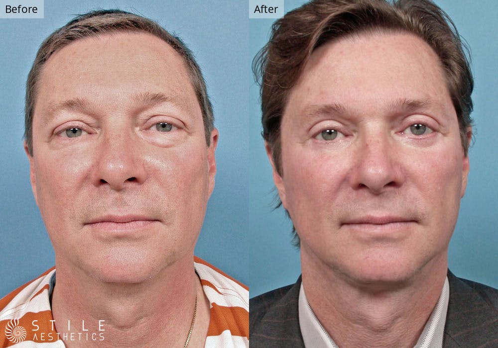 Facelift Before & After Gallery - Patient 192591 - Image 1