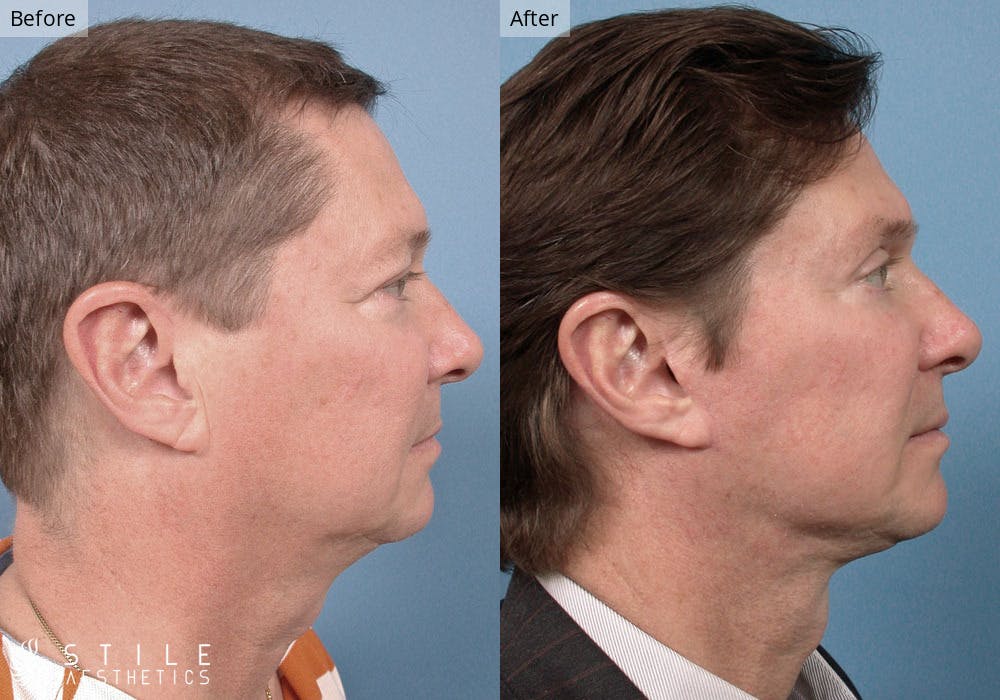 Facelift Before & After Gallery - Patient 192591 - Image 2