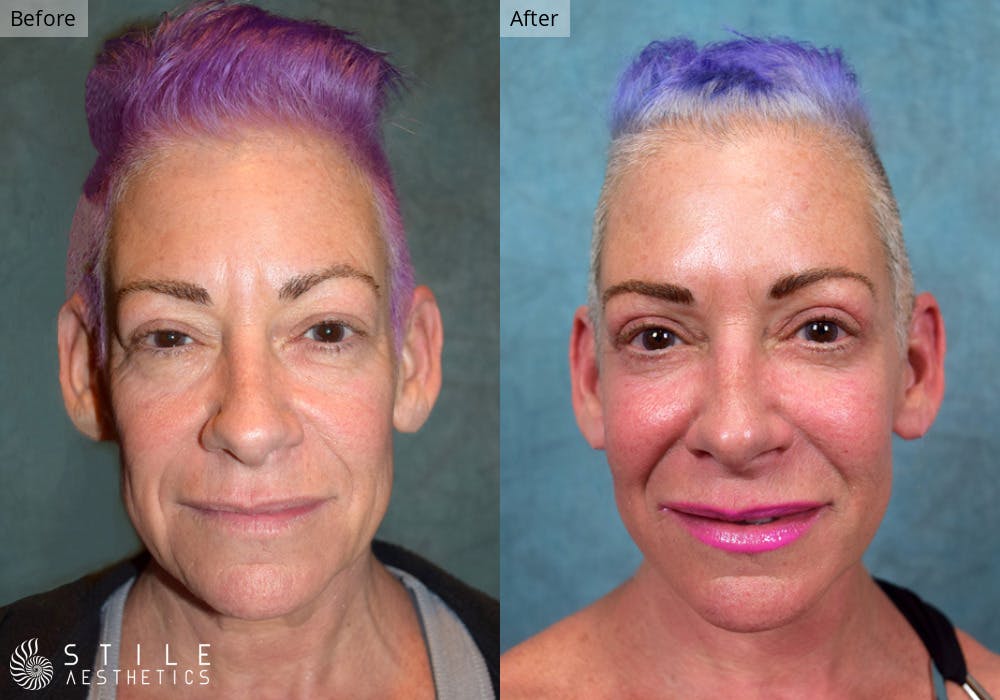 Facelift Before & After Gallery - Patient 327436 - Image 1