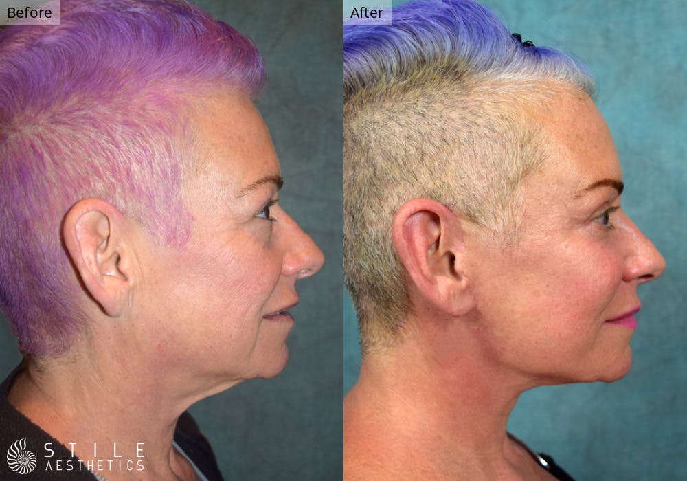Facelift Before & After Gallery - Patient 327436 - Image 2