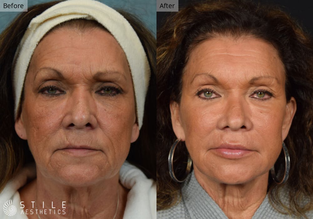 Facelift Before & After Gallery - Patient 112103 - Image 1