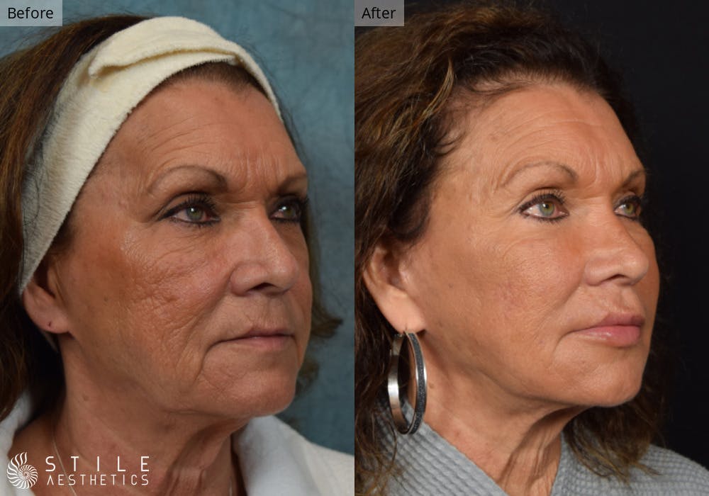 Facelift Before & After Gallery - Patient 112103 - Image 2