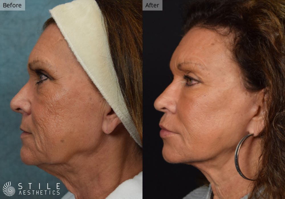 Facelift Before & After Gallery - Patient 112103 - Image 3