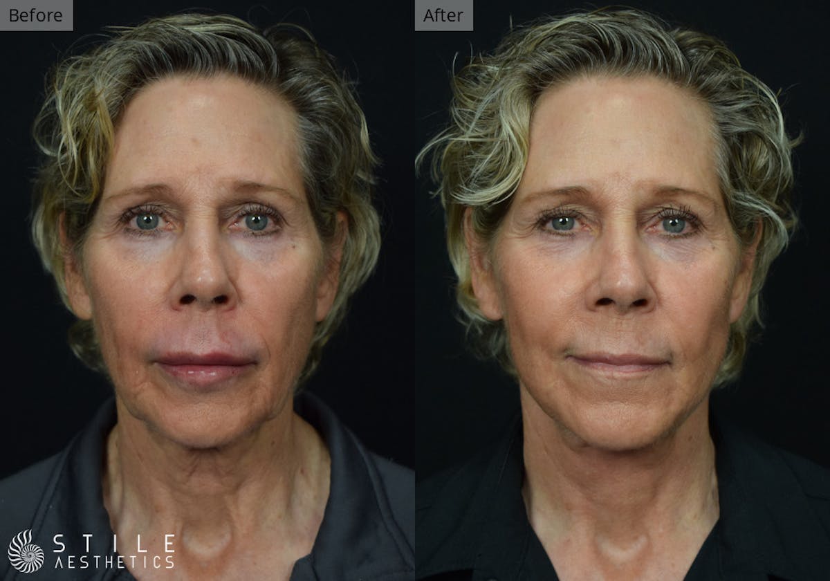 Facelift Before & After Gallery - Patient 188266 - Image 1