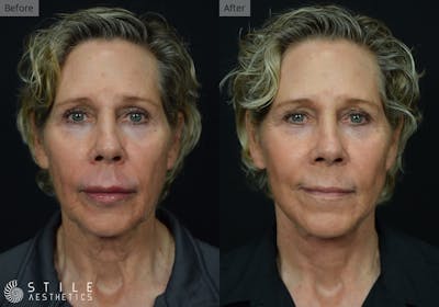 Facelift Before & After Gallery - Patient 188266 - Image 1