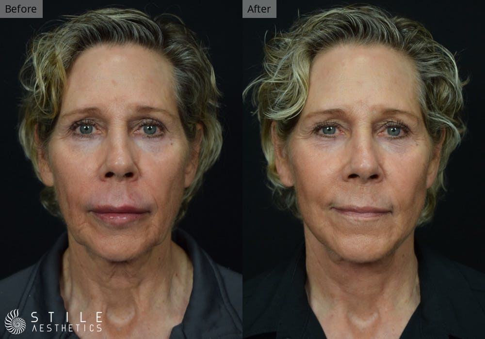 Facelift Before & After Gallery - Patient 188266 - Image 1
