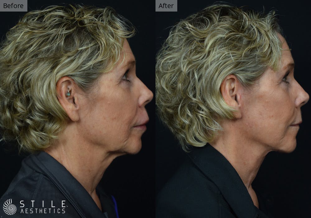 Facelift Before & After Gallery - Patient 188266 - Image 2