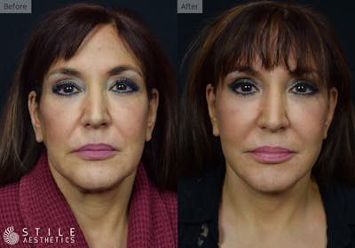 Facelift Before & After Gallery - Patient 367969 - Image 1