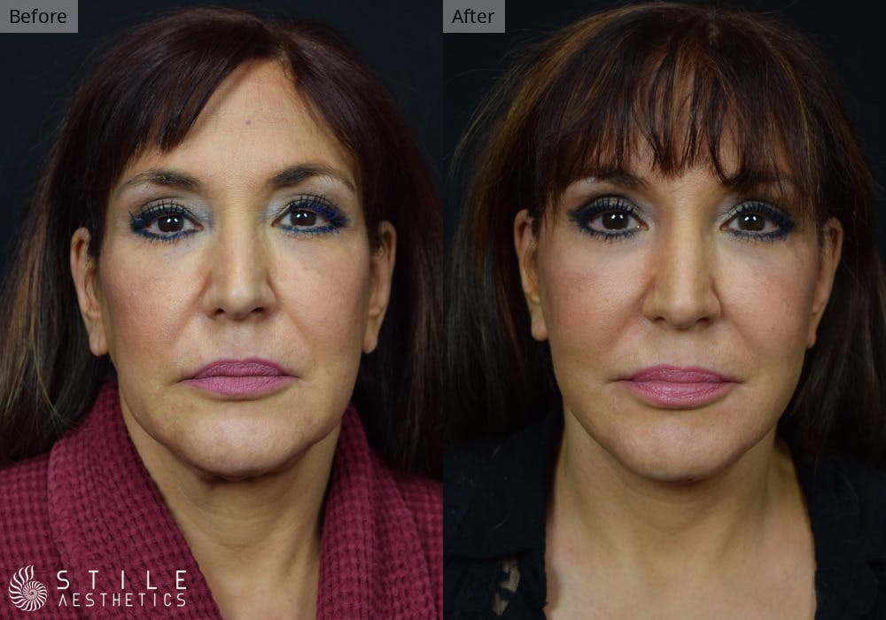 Facelift Before & After Gallery - Patient 367969 - Image 1