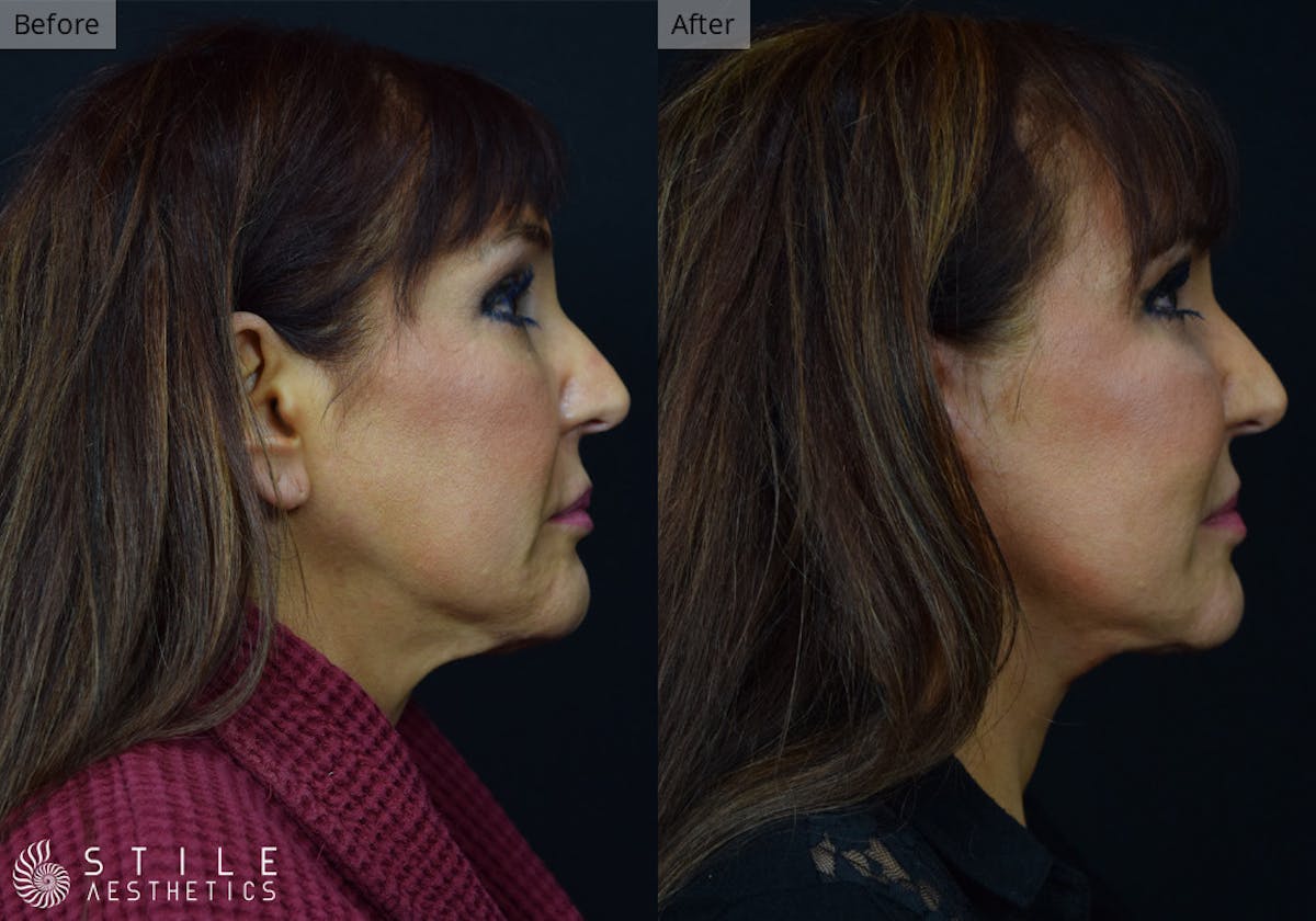 Facelift Before & After Gallery - Patient 367969 - Image 2
