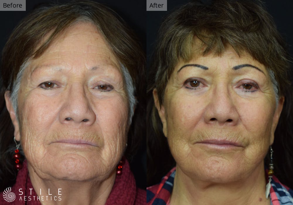 Facelift Before & After Gallery - Patient 190518 - Image 1
