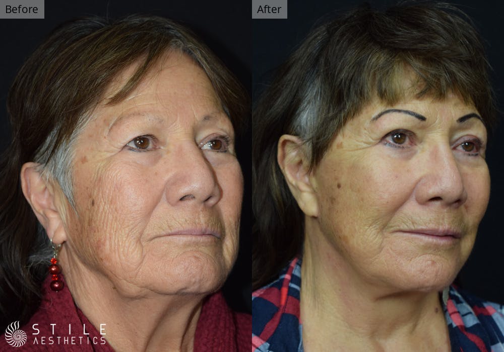 Facelift Before & After Gallery - Patient 190518 - Image 2