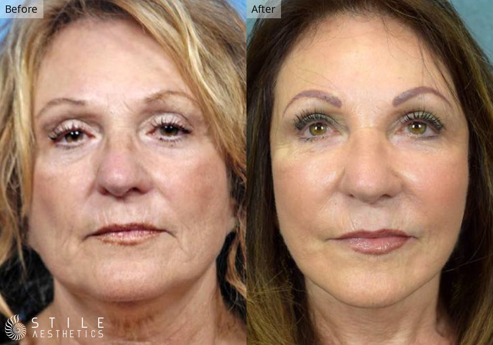 Facelift Before & After Gallery - Patient 493753 - Image 1