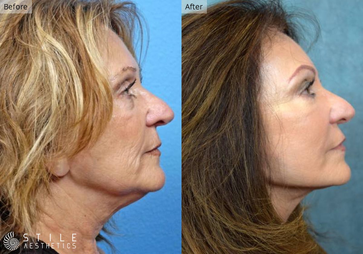 Facelift Before & After Gallery - Patient 493753 - Image 2