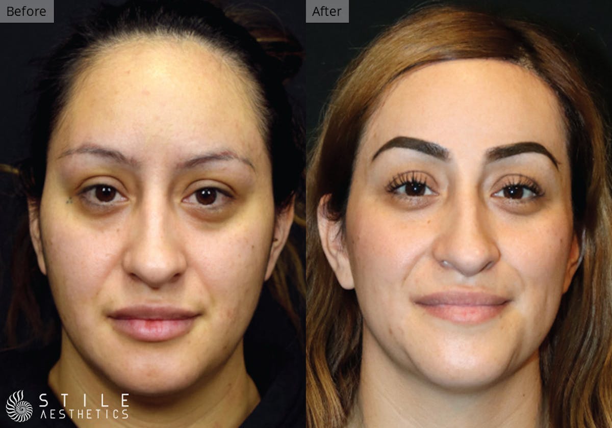 Forehead Reduction Before & After Gallery - Patient 412507 - Image 1