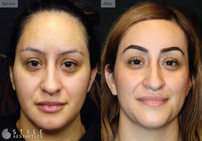 Forehead Reduction Before & After Gallery - Patient 412507 - Image 1