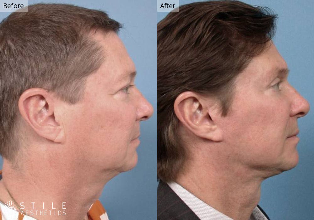 Neck Lift Before & After Gallery - Patient 173796 - Image 1