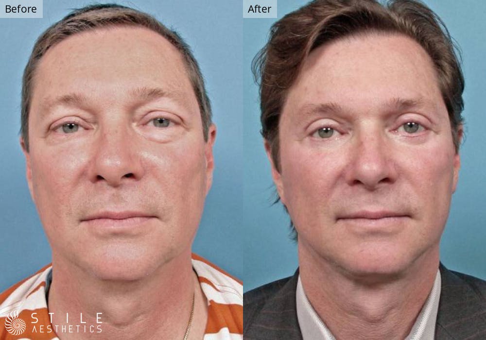 Neck Lift Before & After Gallery - Patient 173796 - Image 2