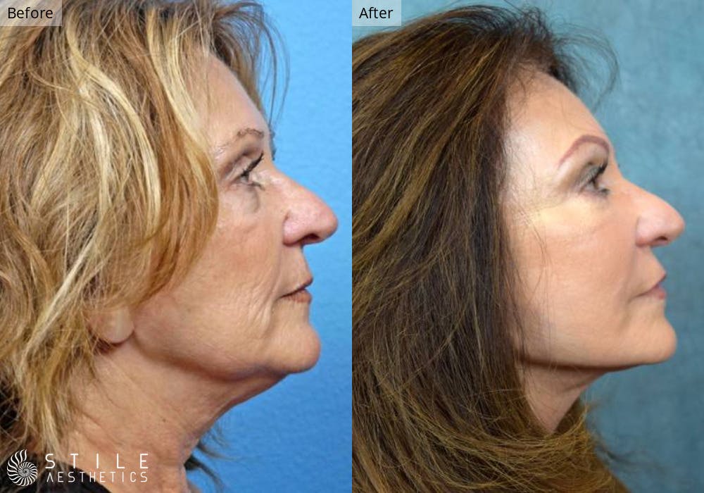 Neck Lift Before & After Gallery - Patient 307065 - Image 1