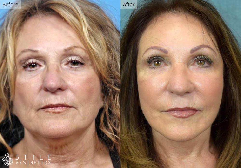 Neck Lift Before & After Gallery - Patient 307065 - Image 2