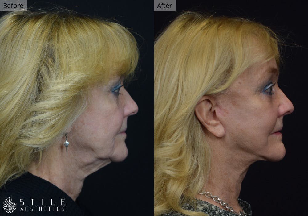Neck Lift Before & After Gallery - Patient 798809 - Image 1
