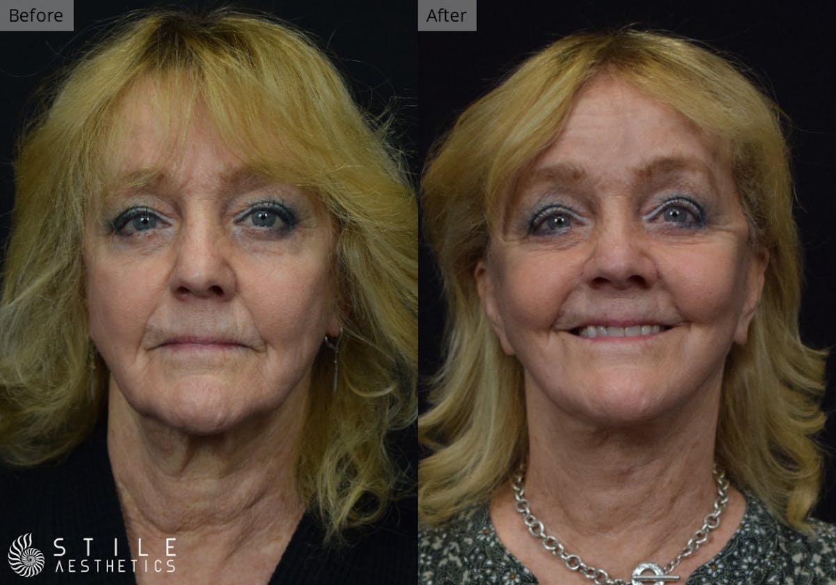 Neck Lift Before & After Gallery - Patient 798809 - Image 2