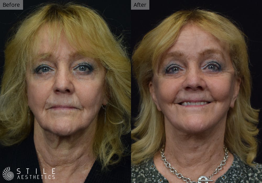 Neck Lift Before & After Gallery - Patient 798809 - Image 2