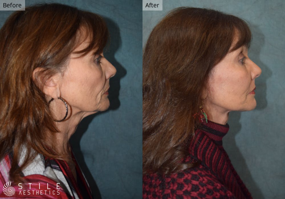 Neck Lift Before & After Gallery - Patient 119212 - Image 1