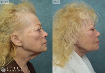Neck Lift Before & After Gallery - Patient 382537 - Image 1