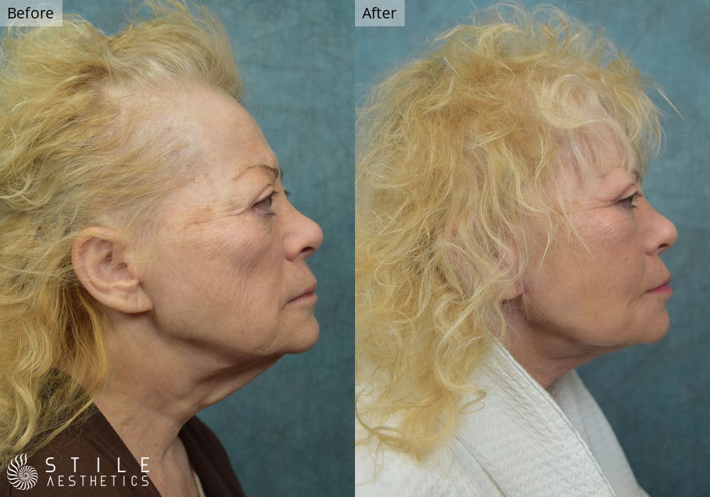 Neck Lift Before & After Gallery - Patient 382537 - Image 1