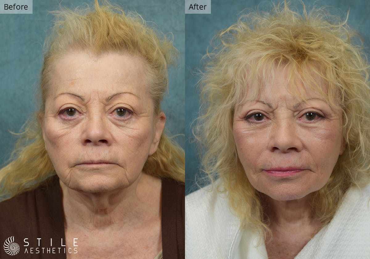 Neck Lift Before & After Gallery - Patient 382537 - Image 2