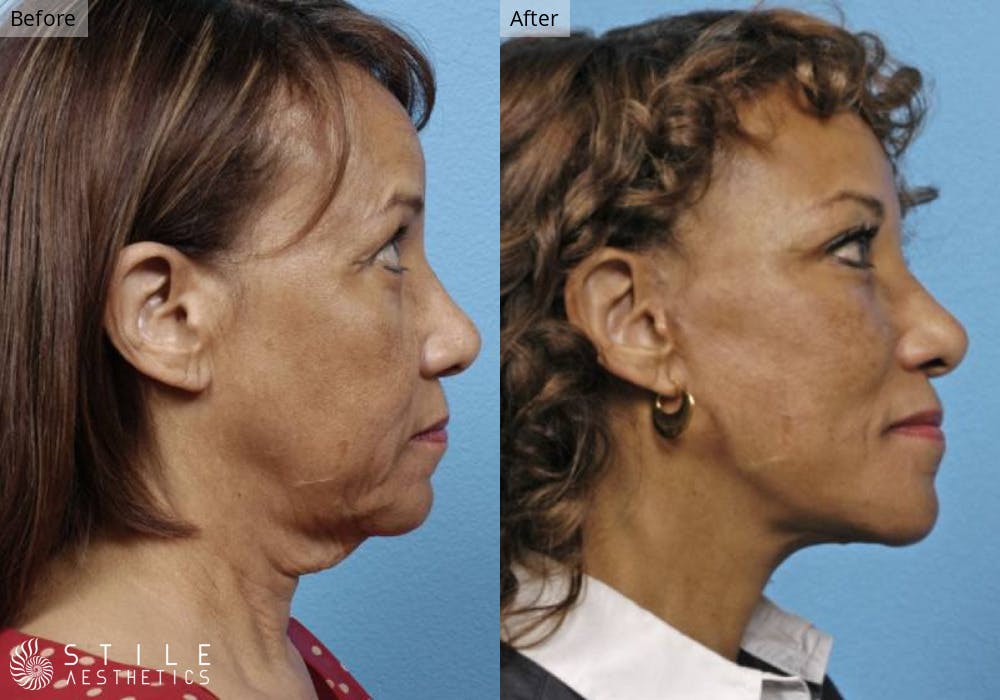 Neck Lift Before & After Gallery - Patient 338495 - Image 1
