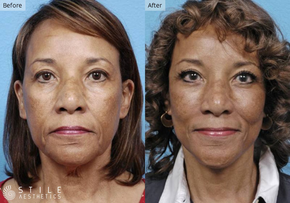 Neck Lift Before & After Gallery - Patient 338495 - Image 2