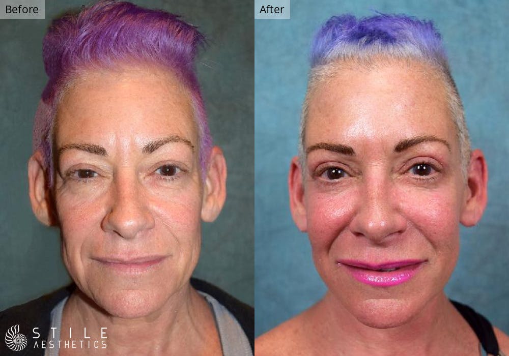 Facial Fat Transfer Before & After Gallery - Patient 123039 - Image 1