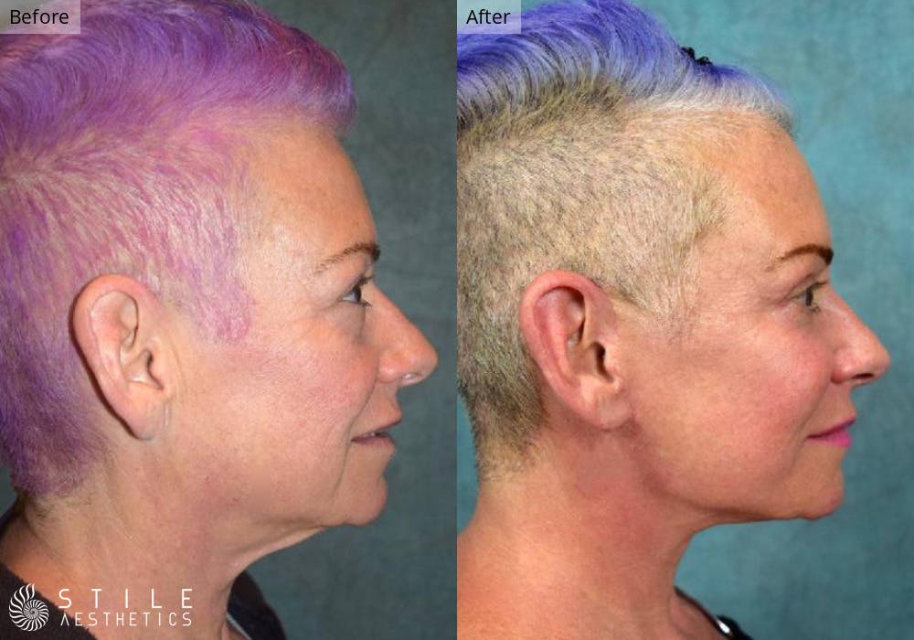 Facial Fat Transfer Before & After Gallery - Patient 123039 - Image 2