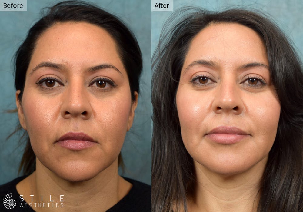 Facial Fat Transfer Before & After Gallery - Patient 420588 - Image 1