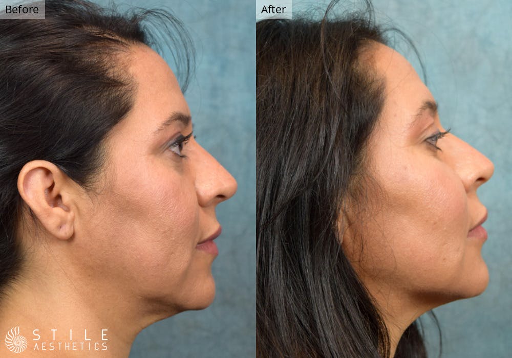 Facial Fat Transfer Before & After Gallery - Patient 420588 - Image 2