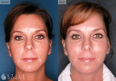 Facial Fat Transfer Before & After Gallery - Patient 427616 - Image 1