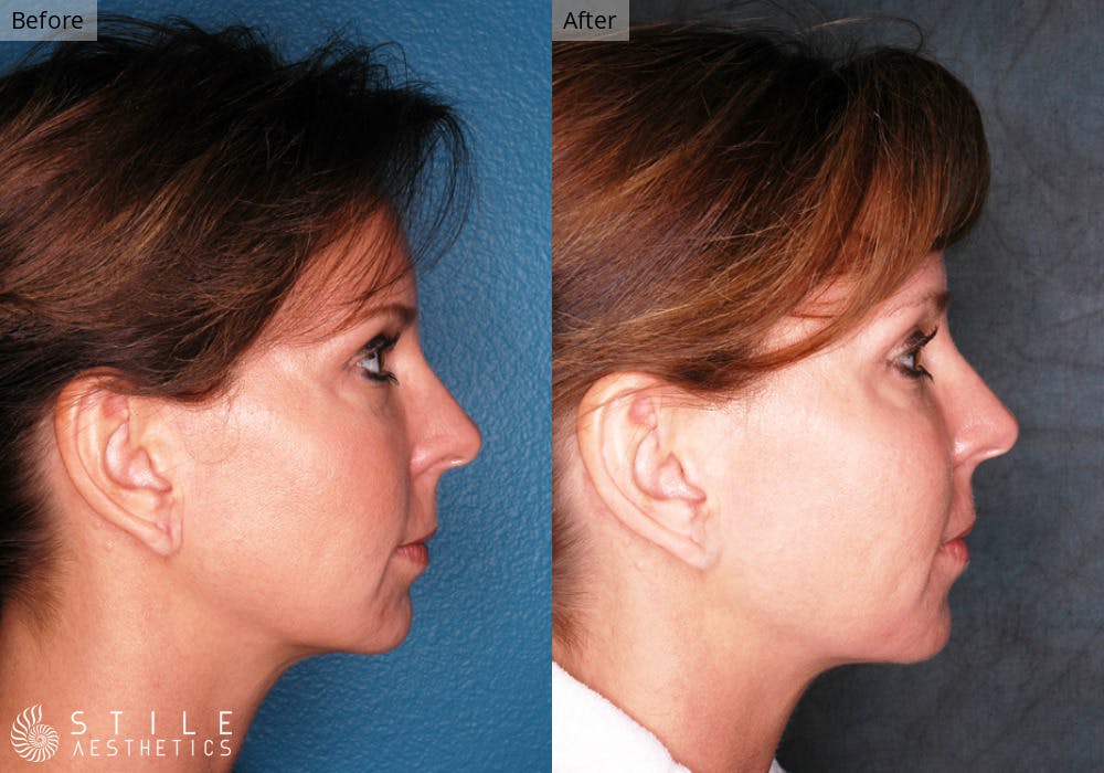 Facial Fat Transfer Before & After Gallery - Patient 427616 - Image 2
