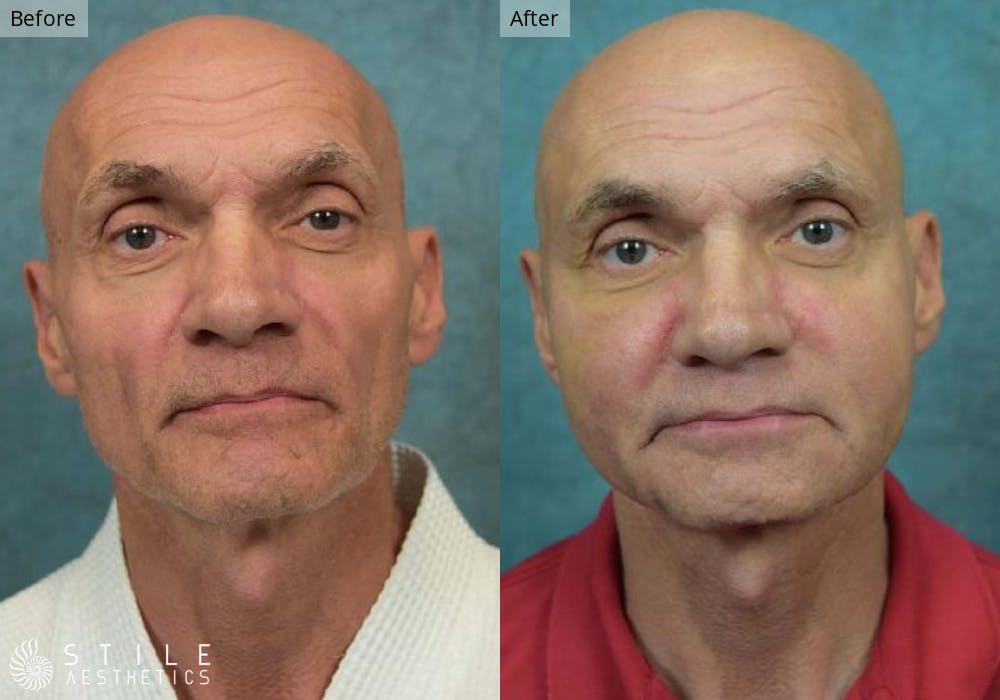 Facial Fat Transfer Before & After Gallery - Patient 327951 - Image 1