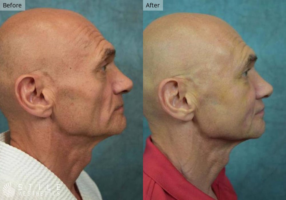 Facial Fat Transfer Before & After Gallery - Patient 327951 - Image 2