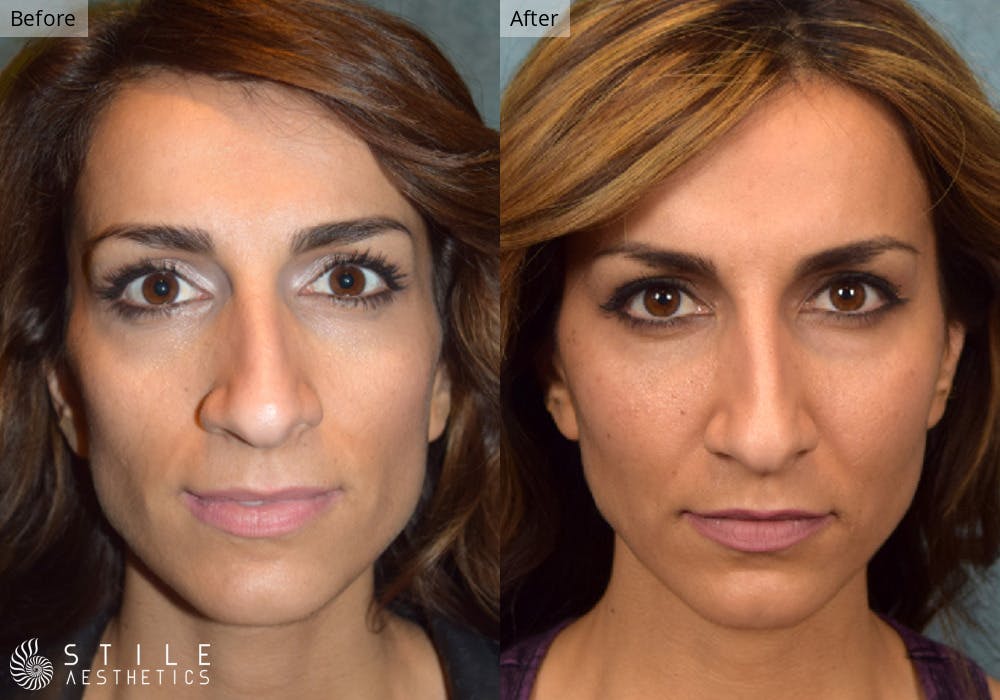Facial Fat Transfer Before & After Gallery - Patient 158991 - Image 1